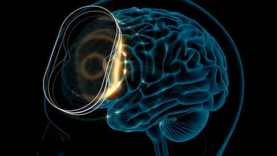 How TMS Works - A Simple Guide to Understanding Its Role in Relieving Depression