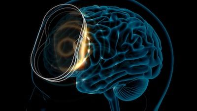 How TMS Works - A Simple Guide to Understanding Its Role in Relieving Depression